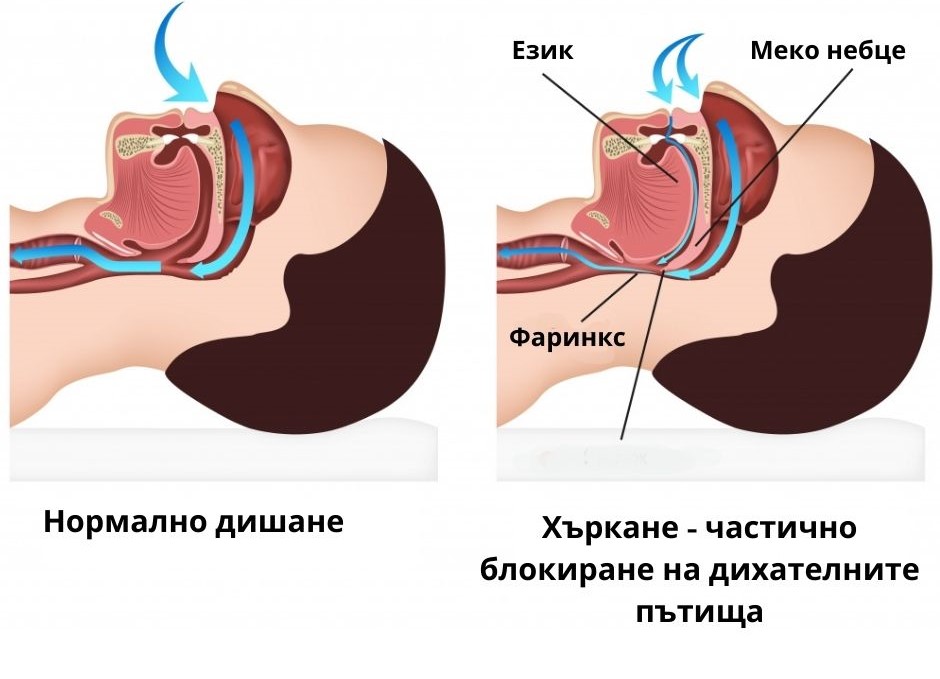 халотерапия срещу хъркане