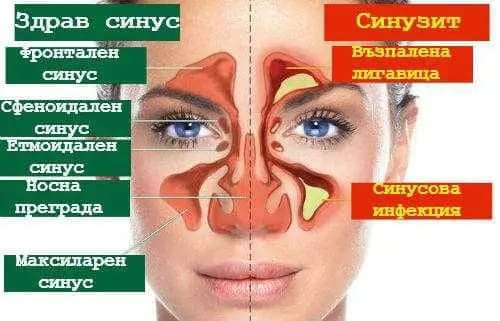 халотерапия при синузит възрастни